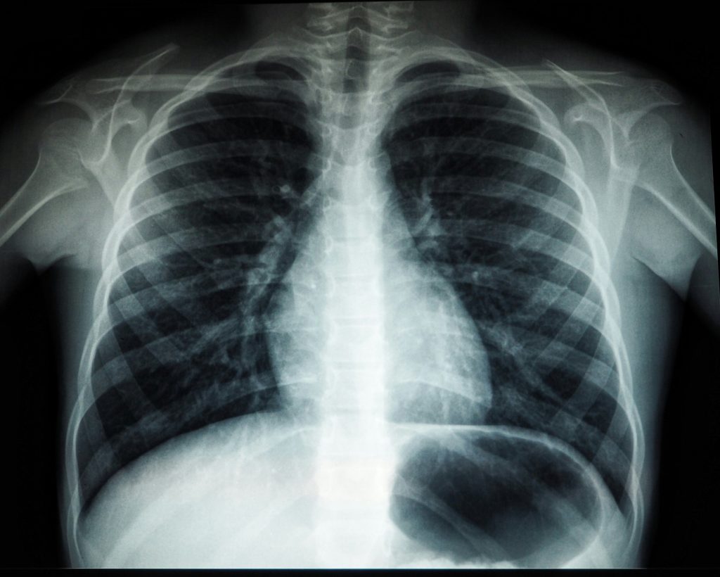 Nanotech platform combining paclitaxel with siRNA boosts immune response against lung cancer